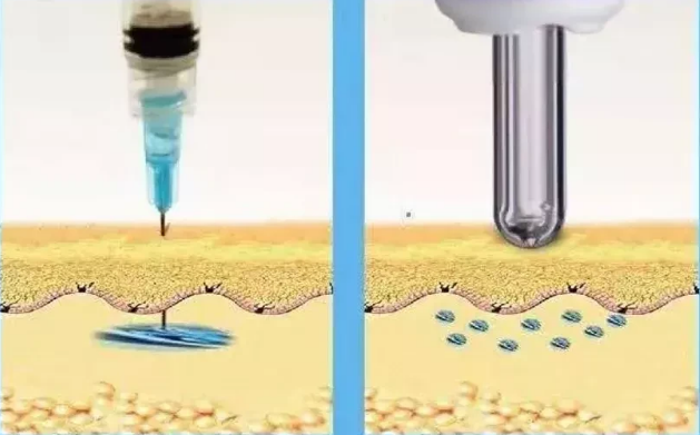 看完無針胰島素注射器的優(yōu)缺點(diǎn)