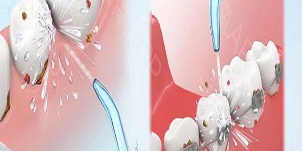 醫(yī)用超聲波洗牙機(jī)好用嗎