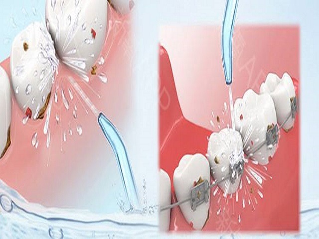 醫(yī)用超聲波洗牙機(jī)好用嗎