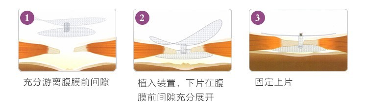 助展式膠膜前疝修補裝置