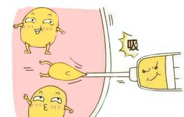 注射器吸脂術(shù)是什么