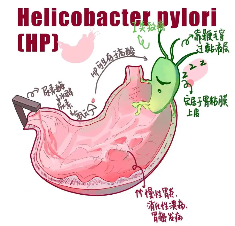 幽門(mén)螺旋桿菌