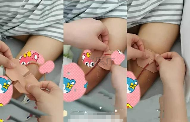 巧用3M宜拉膠帶制作導(dǎo)管固定貼