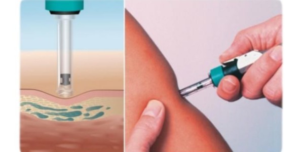 意大利入引無針注射器接種疫苗